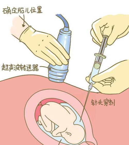 衢州羊水孕期亲子鉴定